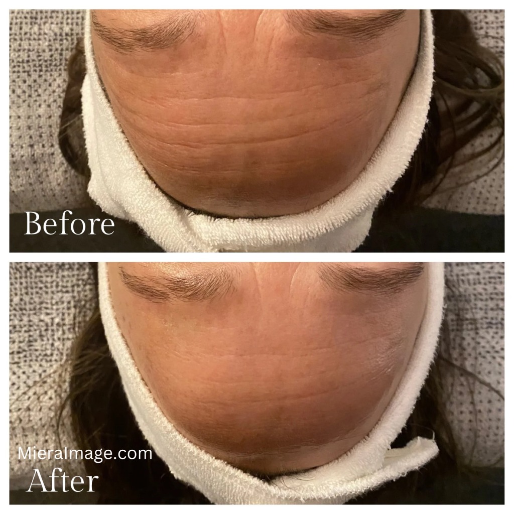 Before and After only one treatment!
